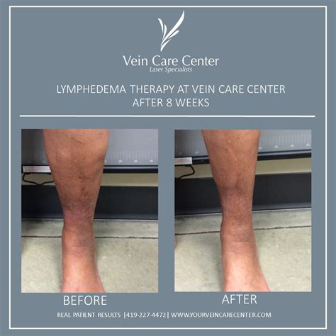Lymphedema Therapy Before And After Lima Ohio Vein Care Center