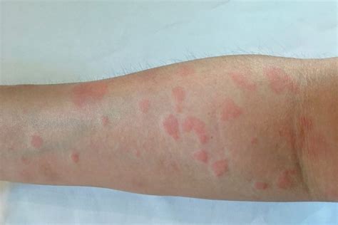 Lupus is an autoimmune disease that takes several forms and can affect many body systems. Study identifies novel lupus drug target