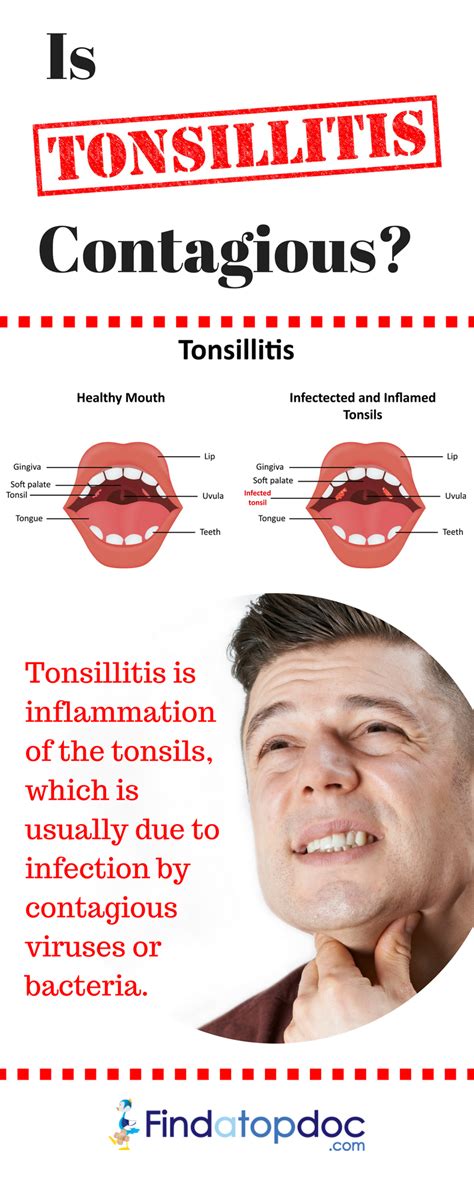 Causes And Symptoms Of Tonsillitis