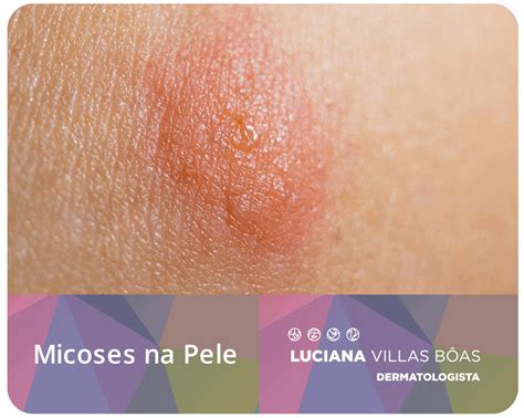 7 Tipos De Micose Na Pele Zohal