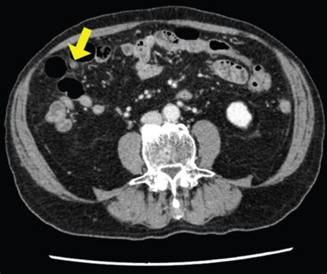 A Contrast Enhanced Abdominal Computed Tomography Ct Scan For Staging