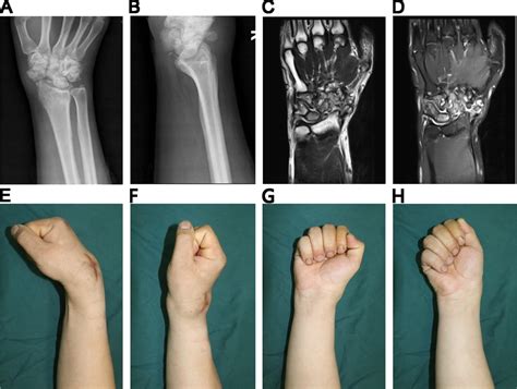 Frontiers Rapid Spontaneous Total Fusion Of Neuropathic Arthropathy Of The Wrist After Limited