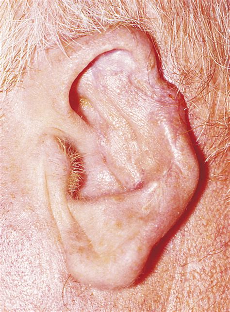 Retroauricular Skin A Flaps Bank For Ear Reconstruction Journal Of