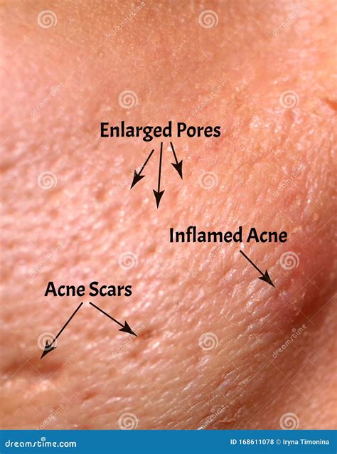 Acne Scars On The Face Royalty Free Stock Photo