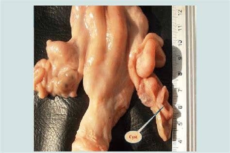 A Photograph Of Ovary With A Hollow Luteal Cyst Cystic Corpus Luteum