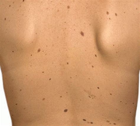 Get Rid Of With Warts Moles Skin Tags Age Spots And