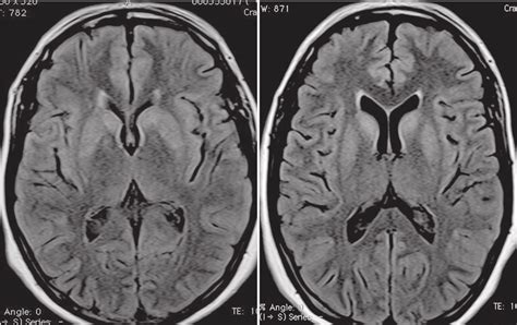 Brain Mri The Patient With Encephalitis Caused By Chikungunya
