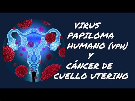 VIRUS papiloma humano y CÁNCER de cuello uterino Como lo causa VPH