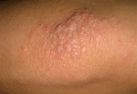 Dermatitis On Elbow Pictures Symptoms And Pictures