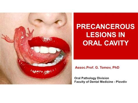 Precancerous Lesions In Oral Cavityprecancerous Lesions In Oral