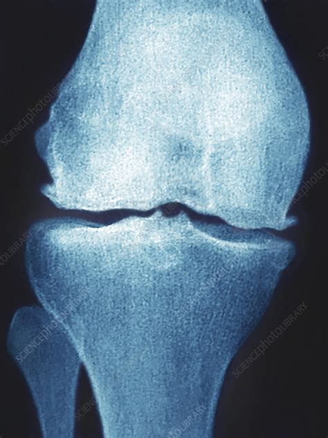 Knee Osteoarthritis X Ray Stock Image C0213890 Science Photo