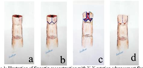 Figure From Evalution Of Bilateral V Y Rotation Advancement Flaps For