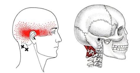 Suboccipital Muscles Trigger Points