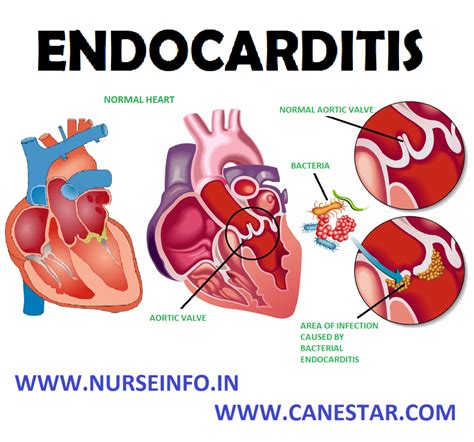 Endocarditis Nurse Info