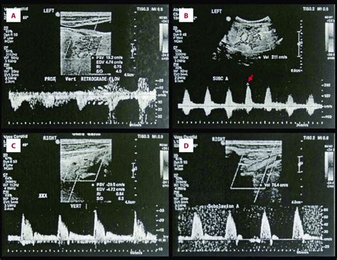 Ultrasound Duplex Scan Of A Left Vertebral Artery Showing Retrograde