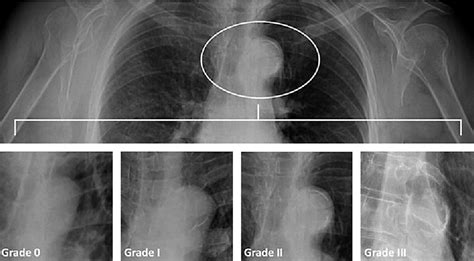 Figure 1 From Relationship Between Aortic Arch Calcification Detected