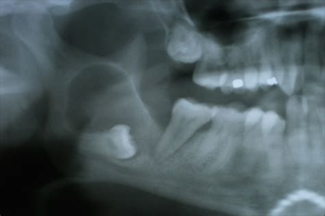 Problems Caused By Wisdom Teeth Anacapa Oral Surgery Dental Implant