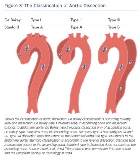 Figure 3 The Classification Of Aortic Dissection Radcliffe Cardiology