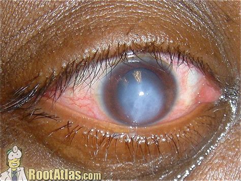 Keratoconus This Photo Shows An Eye That Is Suffering From Acute