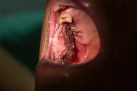 Leukoplakia Tongue Symptoms Figury Oral Hairy Leukoplakia Download