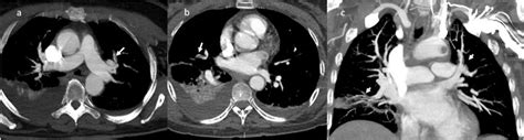 Ct Angiography Presence Of Multiple Contrast Filling Defects Involving