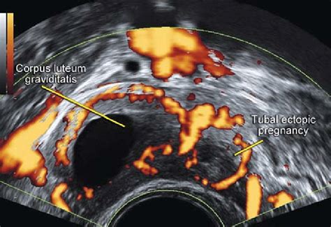Ectopic Tubal Pregnancy And Ipsilateral Corpus Luteum With Double Ring Download Scientific