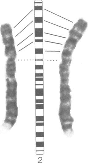 partial karyotype of the proband gtg banding right normal download scientific diagram