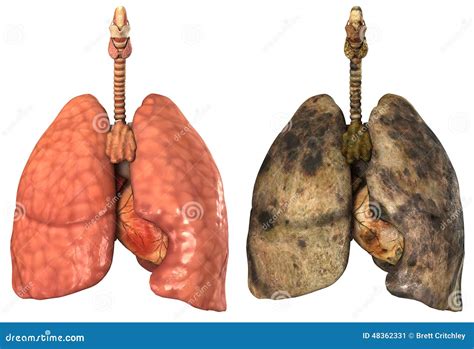 Pulmones Humanos Sanos Y Enfermos Stock De Ilustración Imagen 48362331