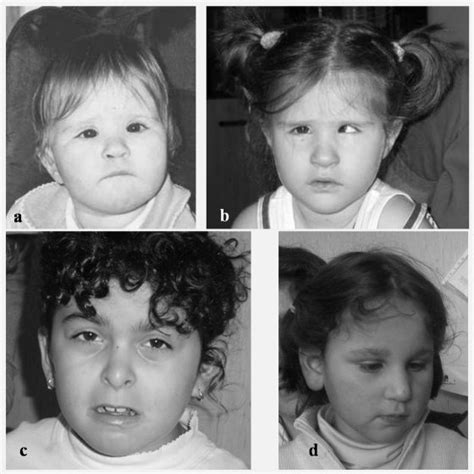 Pictures Of Three Patients With Mental Retardation And Dysmorphisms