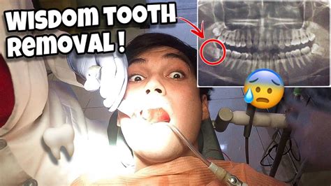 Wisdom Tooth Removal Complicated Surgery Youtube