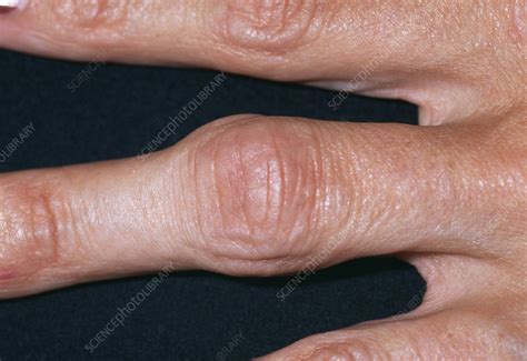 Arthritic Finger Joint Stock Image M1100556 Science Photo Library