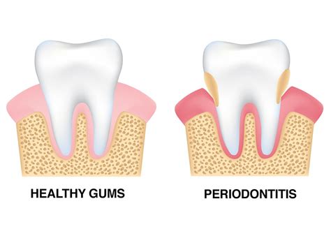 Toronto On Gum Disease And Tooth Loss Periodontal Health Affects