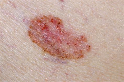 Basal Cell Skin Cancer On The Back Stock Image C0130946 Science