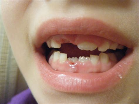 Adults With Baby Teeth Pictures Get More Anythinks