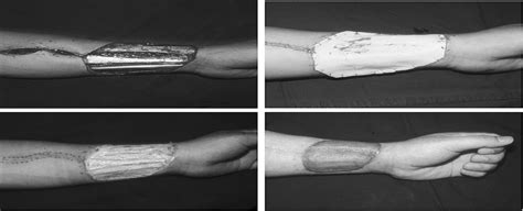Use Of The Artificial Dermis For Free Radial Forearm Flap Do