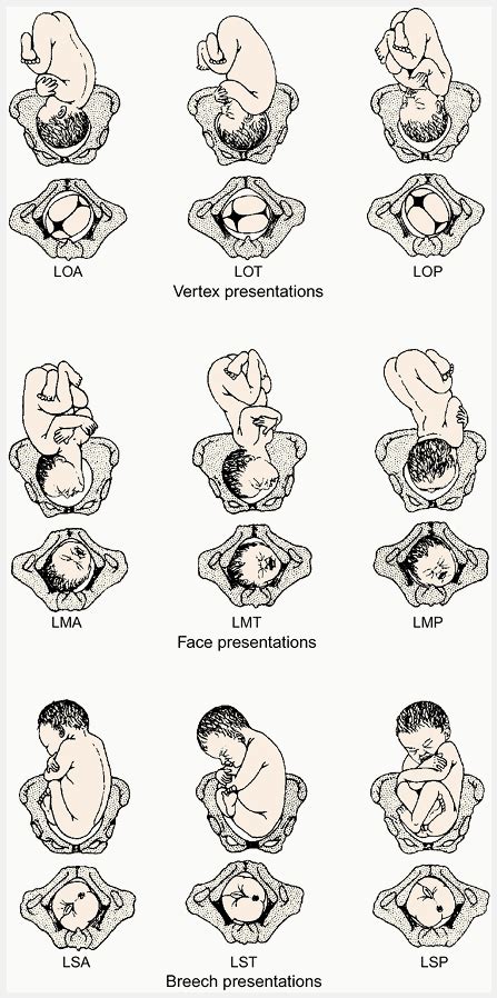 Optimal Fetal Positioning For A Better Birth Baby Position Midwifery