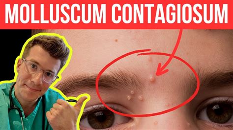 Doctor Explains Molloscum Contagiosum Viral Skin Infection Causes