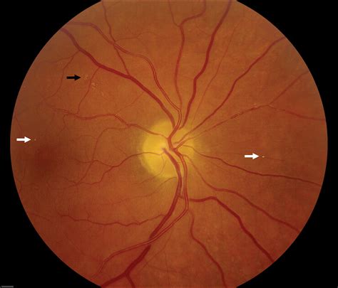 Multiple Retinal Emboli In A Case Of Acute Stroke Practical Neurology
