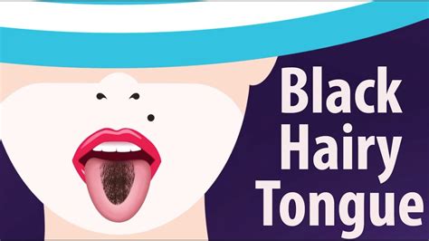 Black Hairy Tongue Causes And Treatment Youtube