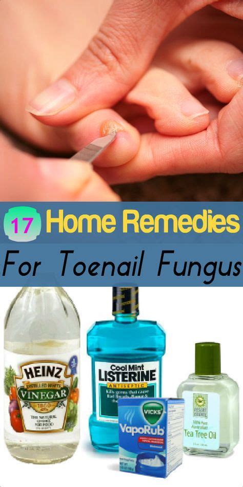 Homeremedyshop 17 Home Remedies For Toenail Fungus Toenail Fungus