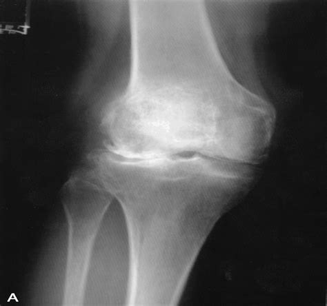 Genu Recurvatum In Total Knee Replacement Clinical Orthopaedics And