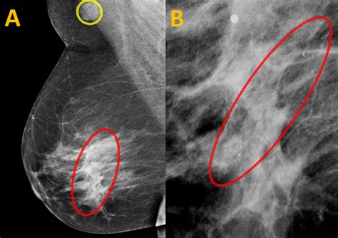 Cureus Spontaneously Disappearing Calcifications In The Breast A