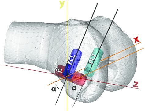 To Avoid Convergence With The Anterior Cruciate Ligament Acl Tunnel