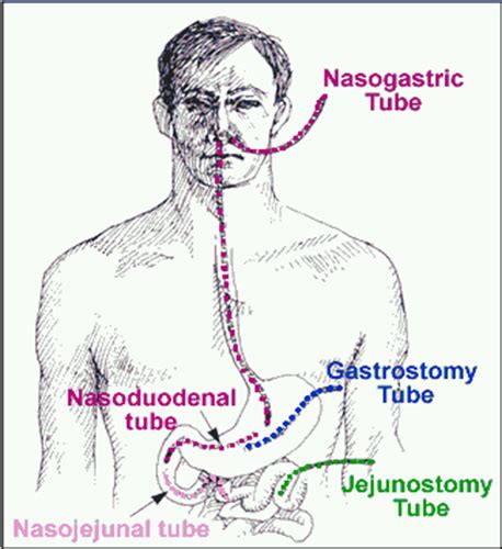 Gi Tubes Tube Enteral Feeding And Ostomies Colostomies