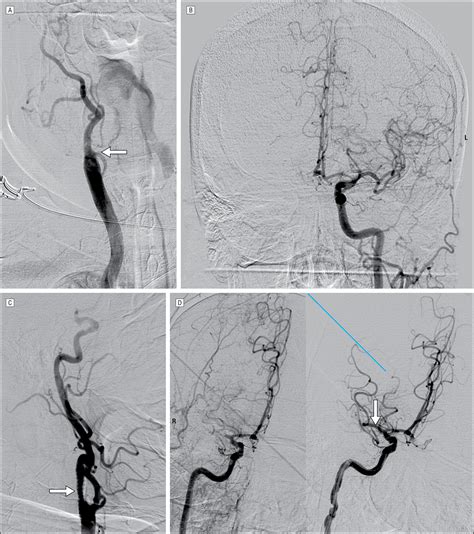 Stroke From Acute Cervical Internal Carotid Artery Occlusion Treatment