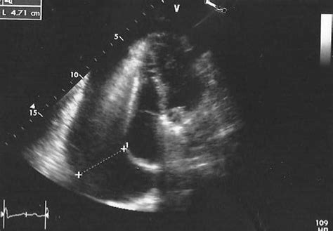 Transthoracic Echocardiogram Showing Pericardial Effusion Download