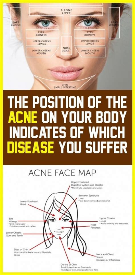 The Position Of Acne On Your Body Shows Which Conditions You Suffer In