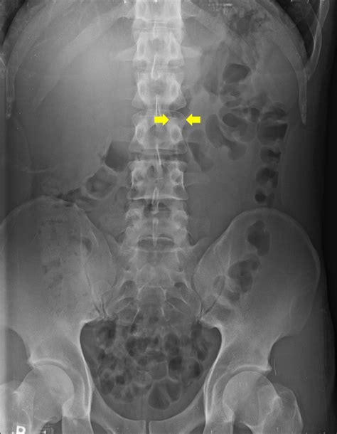 Plain Abdomen X Ray Image At Supine Image Black Colored Contour Of