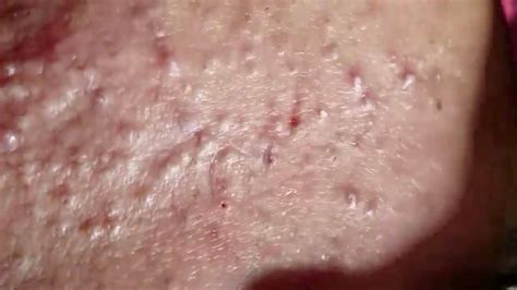 Pimple Popping 2020 Video Blackheads Extraction Blackheads Removal