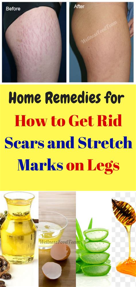 Home Remedies For How To Get Rid Scars And Stretch Marks On Legs